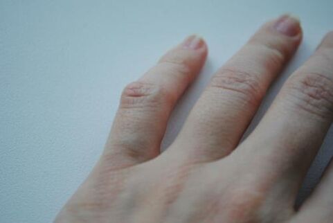 Ant mažojo piršto atsirado artritinis gumbas. 