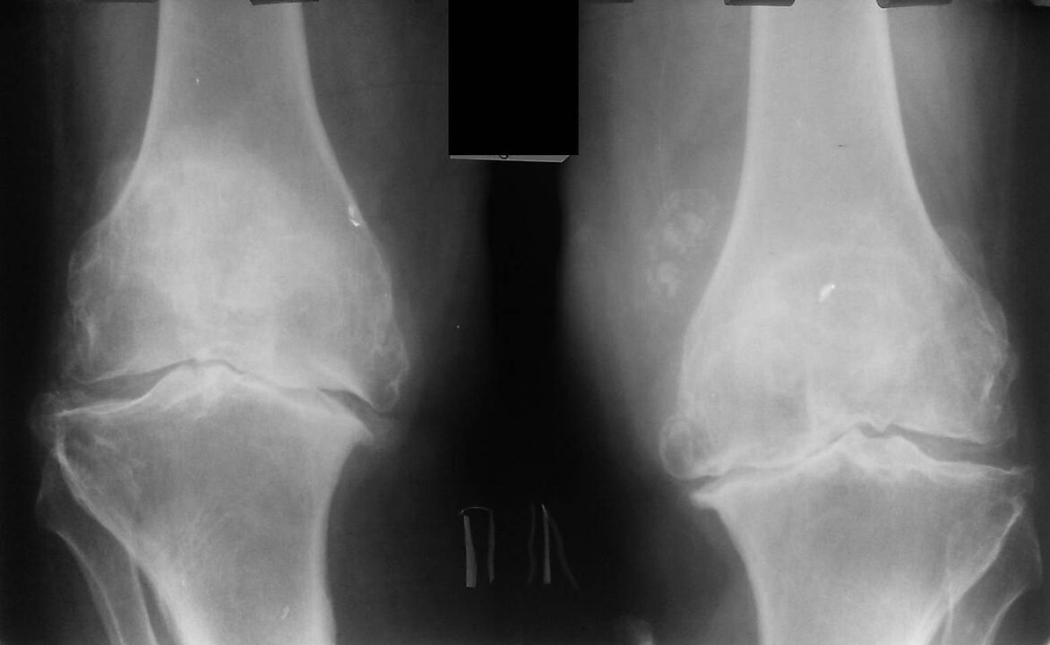 Kelių sąnarių su artroze rentgeno nuotrauka