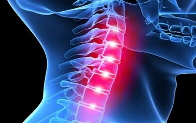 Gimdos kaklelio stuburo osteochondrozės simptomai