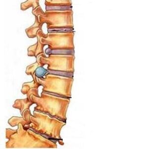 kaip išsivysto gimdos kaklelio regiono osteochondrozė