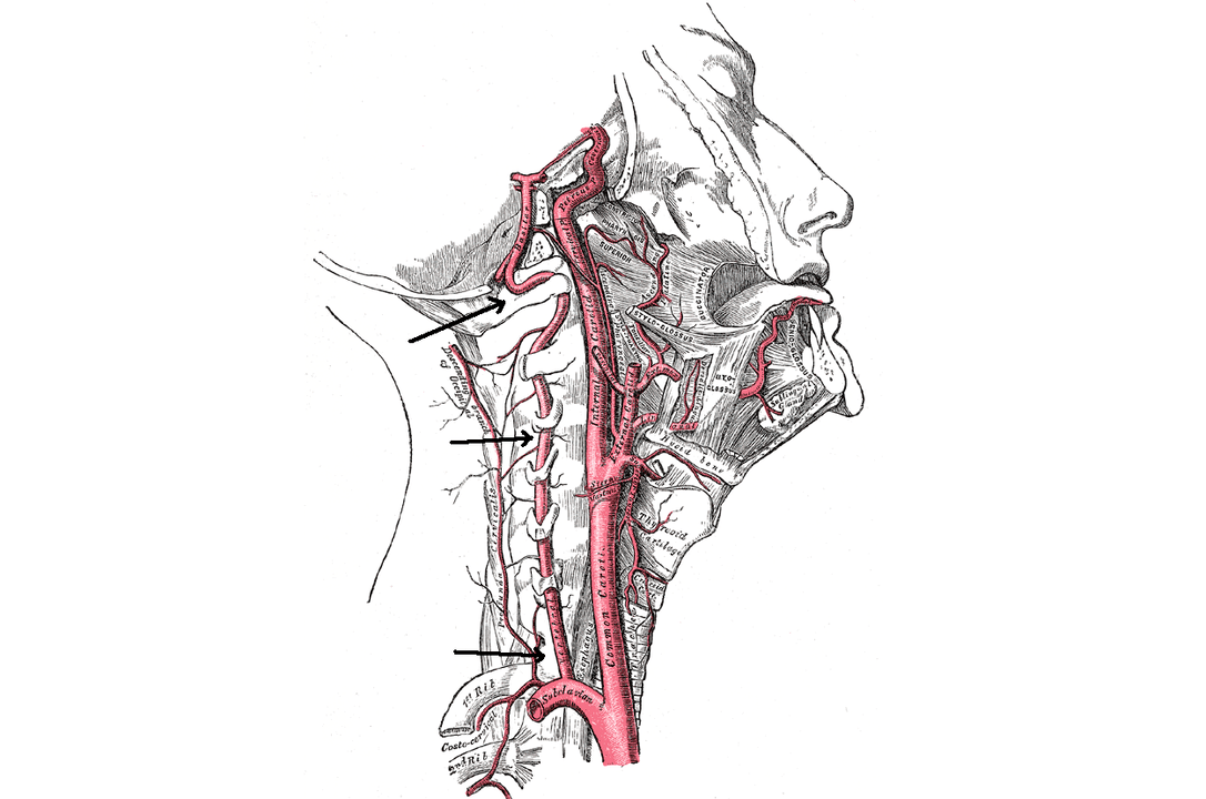 slankstelinės arterijos suspaudimas su gimdos kaklelio osteochondroze