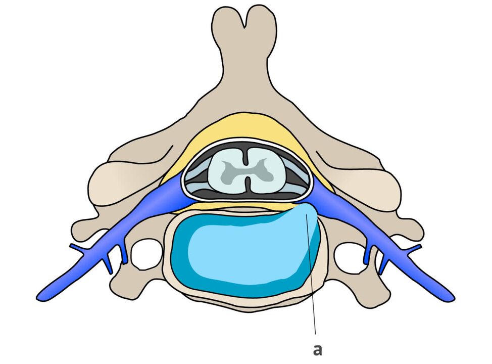 tarpslankstelinė išvarža su gimdos kaklelio osteochondroze
