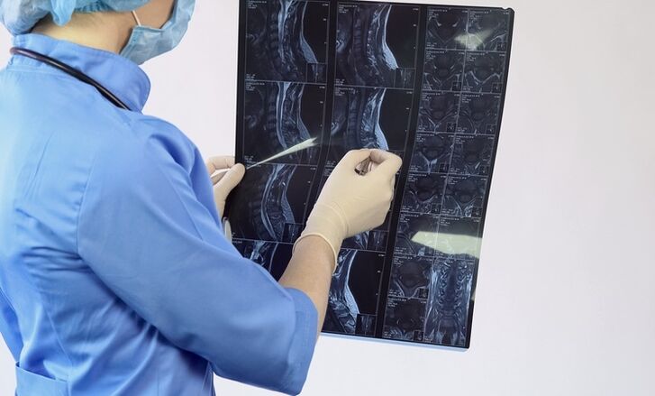 Gimdos kaklelio osteochondrozės diagnozė nustatoma remiantis MRT tyrimu